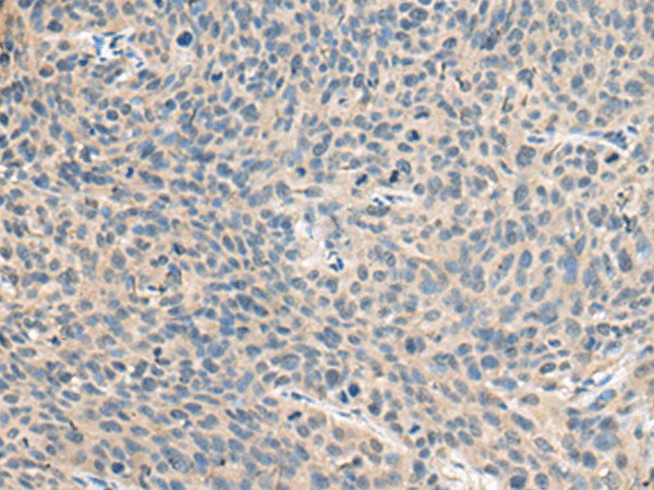 Immunohistochemistry of paraffin-embedded Human cervical cancer tissue  using RNASE1 Polyclonal Antibody at dilution of 1:50(?200)