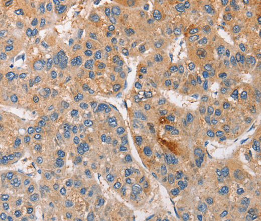 Immunohistochemistry of paraffin-embedded Human liver cancer tissue using CCL4 Polyclonal Antibody at dilution 1:40