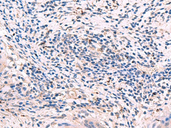 Immunohistochemistry of paraffin-embedded Human cervical cancer tissue  using GKAP1 Polyclonal Antibody at dilution of 1:95(?200)