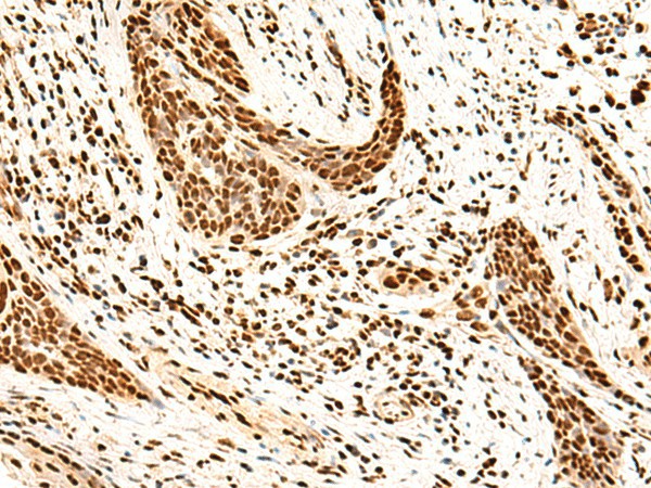 Immunohistochemistry of paraffin-embedded Human esophagus cancer tissue  using SNRPB2 Polyclonal Antibody at dilution of 1:75(?200)