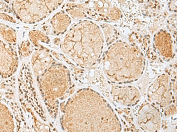 Immunohistochemistry of paraffin-embedded Human thyroid cancer tissue  using HIST1H2BK Polyclonal Antibody at dilution of 1:60(?200)