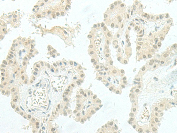 Immunohistochemistry of paraffin-embedded Human thyroid cancer tissue  using ESRP2 Polyclonal Antibody at dilution of 1:95(?200)