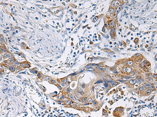 Immunohistochemistry of paraffin-embedded Human esophagus cancer tissue  using HSDL2 Polyclonal Antibody at dilution of 1:80(?200)