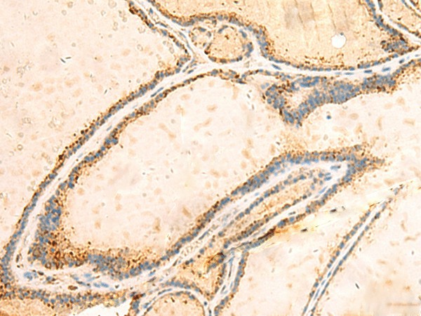 Immunohistochemistry of paraffin-embedded Human thyroid cancer tissue  using IGFBPL1 Polyclonal Antibody at dilution of 1:55(?200)