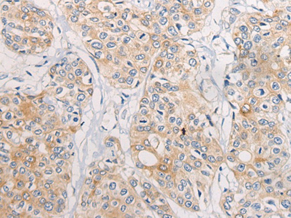 Immunohistochemistry of paraffin-embedded Human prost at e cancer tissue  using CPD Polyclonal Antibody at dilution of 1:70(?200)