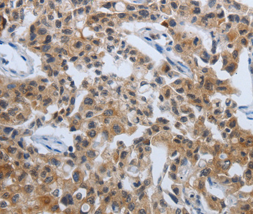 Immunohistochemistry of paraffin-embedded Human lung cancer tissue using PDCD7 Polyclonal Antibody at dilution 1:60