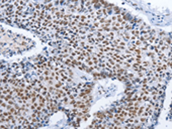 Immunohistochemistry of paraffin-embedded Human lung cancer tissue  using GNRH1 Polyclonal Antibody at dilution of 1:70(?200)