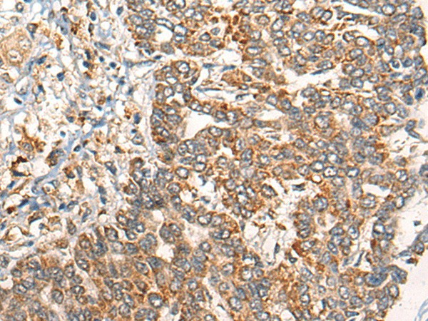 Immunohistochemistry of paraffin-embedded Human liver cancer tissue  using EPHA6 Polyclonal Antibody at dilution of 1:40(?200)