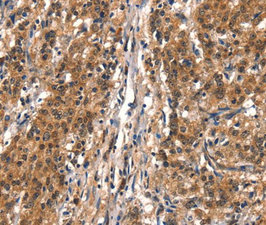 Immunohistochemistry of paraffin-embedded Human gastric cancer tissue using DDX4 Polyclonal Antibody at dilution 1:40