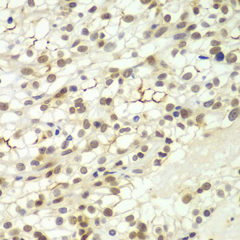 Immunohistochemistry of paraffin-embedded Human kidney cancer using LHX4 Polyclonal Antibody at dilution of 1:100 (40x lens).