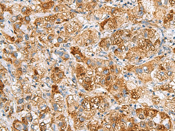 Immunohistochemistry of paraffin-embedded Human liver cancer tissue  using NMU Polyclonal Antibody at dilution of 1:80(?200)