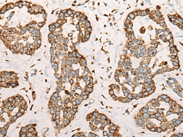 Immunohistochemistry of paraffin-embedded Human esophagus cancer tissue  using CAPN9 Polyclonal Antibody at dilution of 1:45(?200)