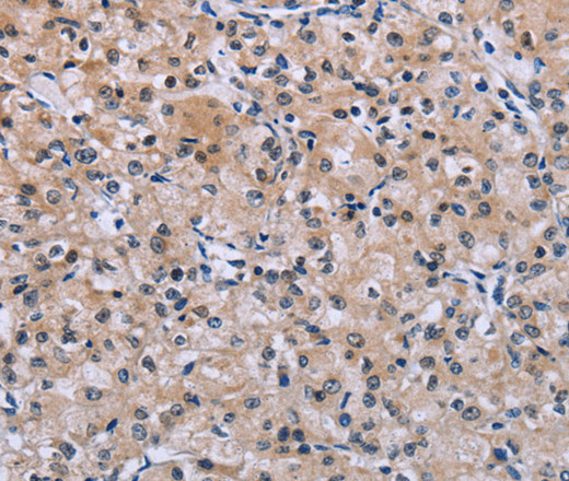 Immunohistochemistry of paraffin-embedded Human prostate cancer using SLC1A6 Polyclonal Antibody at dilution of 1:40