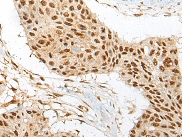 Immunohistochemistry of paraffin-embedded Human esophagus cancer tissue  using ATE1 Polyclonal Antibody at dilution of 1:60(?200)