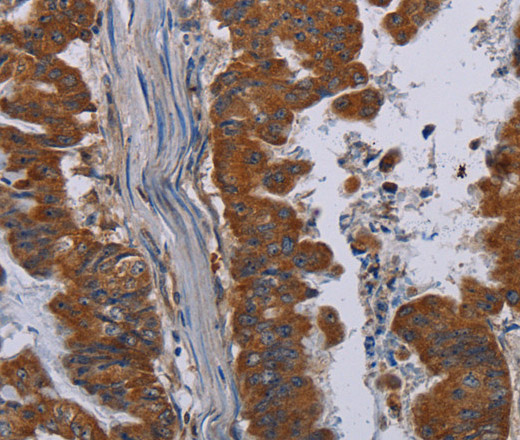 Immunohistochemistry of paraffin-embedded Human esophagus cancer tissue using NECTIN3 Polyclonal Antibody at dilution 1:40