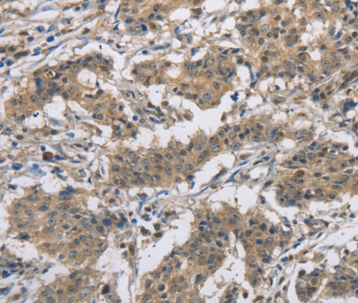 Immunohistochemistry of paraffin-embedded Human gastric cancer tissue using DSG2 Polyclonal Antibody at dilution 1:50