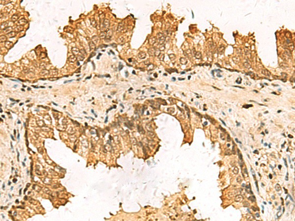 Immunohistochemistry of paraffin-embedded Human prost at e cancer tissue  using PDXK Polyclonal Antibody at dilution of 1:75(?200)