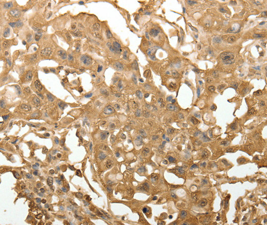 Immunohistochemistry of paraffin-embedded Human lung cancer using TXN Polyclonal Antibody at dilution of 1:40