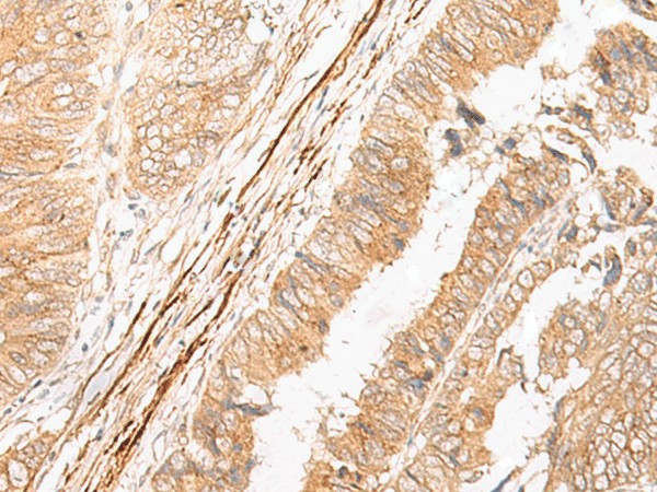 Immunohistochemistry of paraffin-embedded Human colorectal cancer tissue  using EPS15 Polyclonal Antibody at dilution of 1:50(?200)