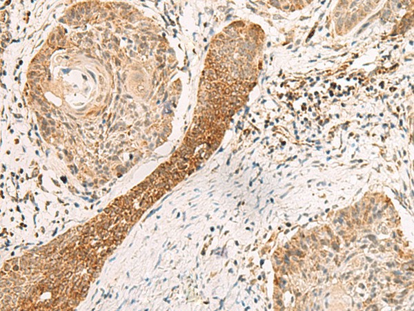 Immunohistochemistry of paraffin-embedded Human esophagus cancer tissue  using EXD2 Polyclonal Antibody at dilution of 1:55(?200)