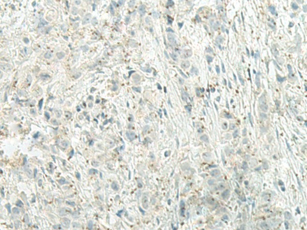 Immunohistochemistry of paraffin-embedded Human breast cancer tissue  using UQCC2 Polyclonal Antibody at dilution of 1:60(?200)