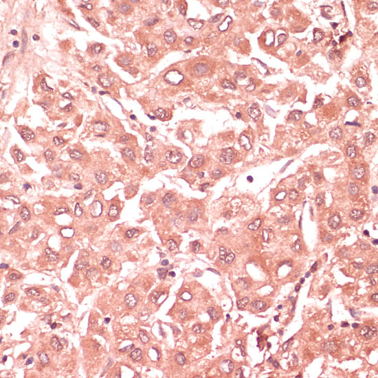 Immunohistochemistry of paraffin-embedded Human liver cancer using RNF5 Polyclonal Antibody at dilution of 1:100 (40x lens).