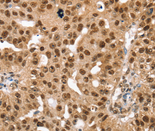 Immunohistochemistry of paraffin-embedded Human breast cancer using SMARCB1 Polyclonal Antibody at dilution of 1:30