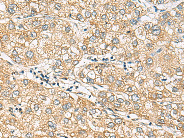 Immunohistochemistry of paraffin-embedded Human liver cancer tissue  using DACT3 Polyclonal Antibody at dilution of 1:70(?200)