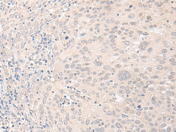 Immunohistochemistry of paraffin-embedded Human cervical cancer tissue  using FOXRED2 Polyclonal Antibody at dilution of 1:35(?200)