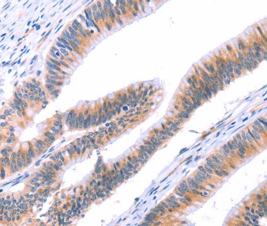 Immunohistochemistry of paraffin-embedded Human colon cancer tissue using VWF Polyclonal Antibody at dilution 1:50