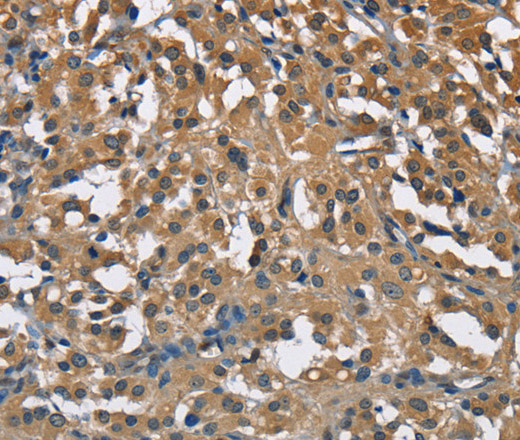 Immunohistochemistry of paraffin-embedded Human thyroid cancer using ENO1 Polyclonal Antibody at dilution of 1:40