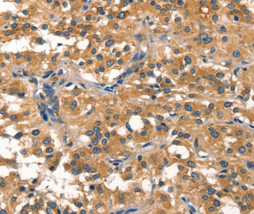 Immunohistochemistry of paraffin-embedded Human thyroid cancer using EIF4G1 Polyclonal Antibody at dilution of 1:30