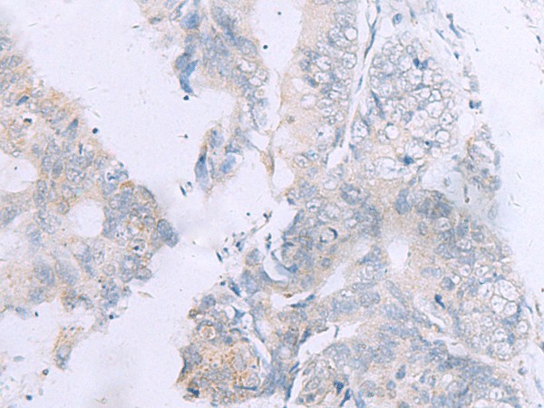 Immunohistochemistry of paraffin-embedded Human colorectal cancer tissue  using GPC3 Polyclonal Antibody at dilution of 1:60(?200)