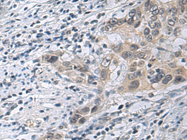 Immunohistochemistry of paraffin-embedded Human esophagus cancer tissue  using IRS4 Polyclonal Antibody at dilution of 1:45(?200)