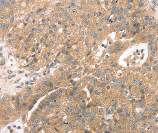 Immunohistochemistry of paraffin-embedded Human breast cancer using STX10 Polyclonal Antibody at dilution of 1:45