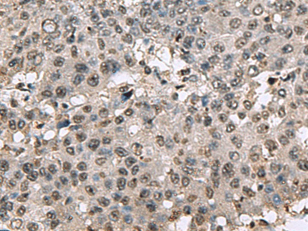 Immunohistochemistry of paraffin-embedded Human liver cancer tissue  using TMX3 Polyclonal Antibody at dilution of 1:70(?200)