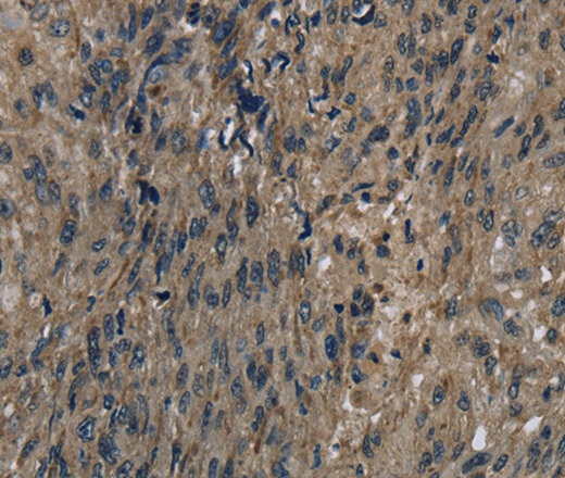 Immunohistochemistry of paraffin-embedded Human esophagus cancer using FTO Polyclonal Antibody at dilution of 1:60