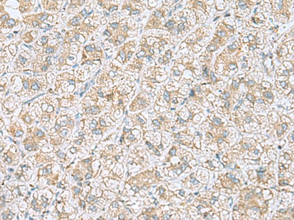 Immunohistochemistry of paraffin-embedded Human liver cancer tissue  using NDRG4 Polyclonal Antibody at dilution of 1:45(?200)