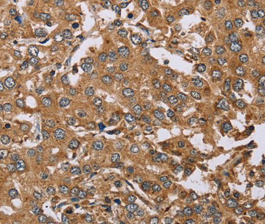 Immunohistochemistry of paraffin-embedded Human liver cancer using DDAH1 Polyclonal Antibody at dilution of 1:50