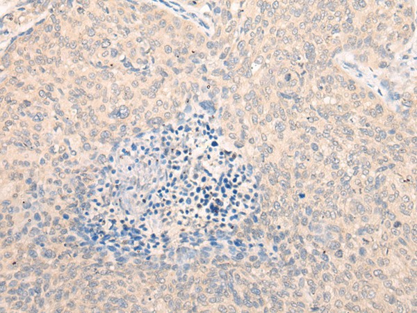 Immunohistochemistry of paraffin-embedded Human cervical cancer tissue  using SEPT10 Polyclonal Antibody at dilution of 1:25(?200)