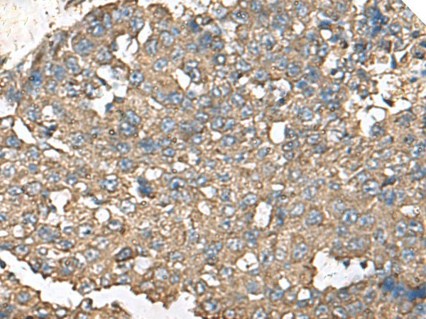 Immunohistochemistry of paraffin-embedded Human liver cancer tissue  using RPS14 Polyclonal Antibody at dilution of 1:50(?200)