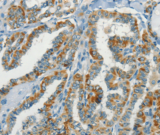 Immunohistochemistry of paraffin-embedded Human thyroid cancer tissue using NPAP1 Polyclonal Antibody at dilution 1:70