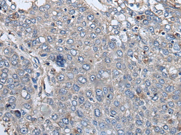 Immunohistochemistry of paraffin-embedded Human liver cancer tissue  using RIPK1 Polyclonal Antibody at dilution of 1:85(?200)