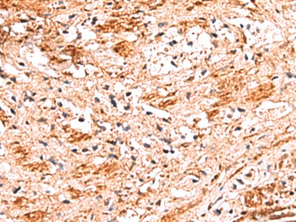 Immunohistochemistry of paraffin-embedded Human liver cancer tissue  using NADK Polyclonal Antibody at dilution of 1:70(?200)