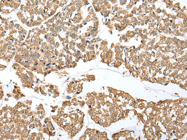 Immunohistochemistry of paraffin-embedded Human esophagus cancer tissue  using NDUFB3 Polyclonal Antibody at dilution of 1:25(?200)