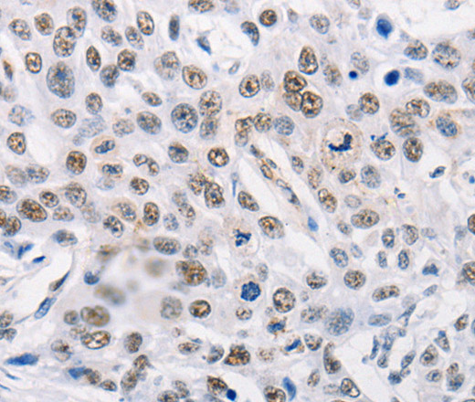 Immunohistochemistry of paraffin-embedded Human esophagus cancer using TRIM63 Polyclonal Antibody at dilution of 1:60