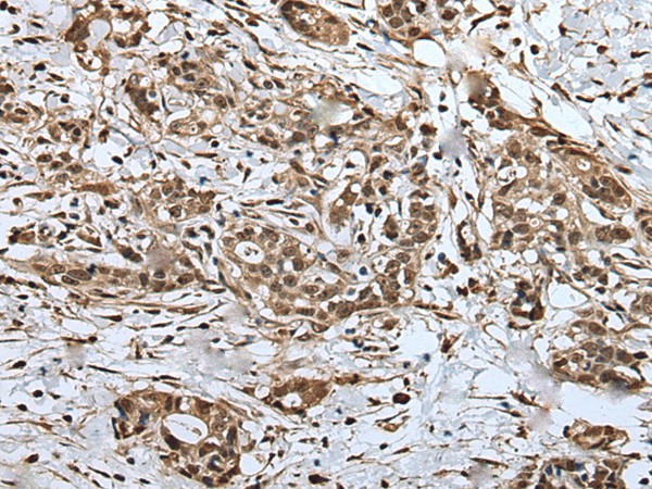 Immunohistochemistry of paraffin-embedded Human gastric cancer tissue  using UPK3A Polyclonal Antibody at dilution of 1:30(?200)