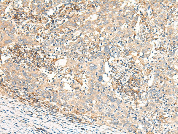 Immunohistochemistry of paraffin-embedded Human cervical cancer tissue  using GBP4 Polyclonal Antibody at dilution of 1:30(?200)