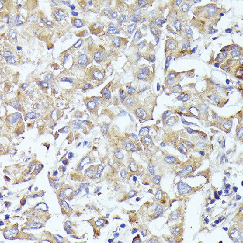 Immunohistochemistry of paraffin-embedded Human liver cancer using EIF3L Polyclonal Antibody at dilution of  1:100 (40x lens).