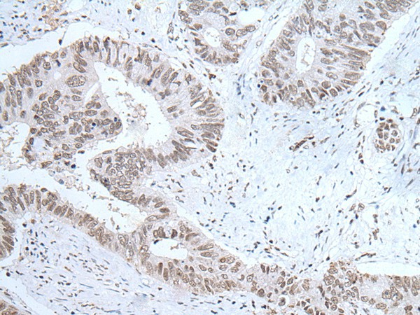 Immunohistochemistry of paraffin-embedded Human colorectal cancer tissue  using HCRT Polyclonal Antibody at dilution of 1:25(?200)